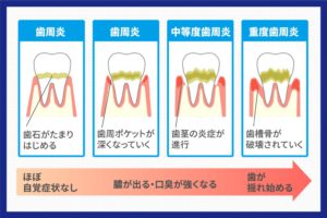 periodontal-disease-2-1024x683